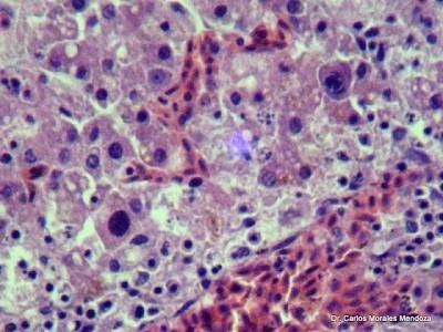 Histopatología hepática con cuerpos de inclusión intranucleares compatibles con FAdV-11